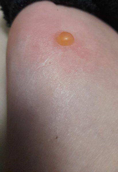 Bloody hell, it's a bit early for mosquitos isn't it?!