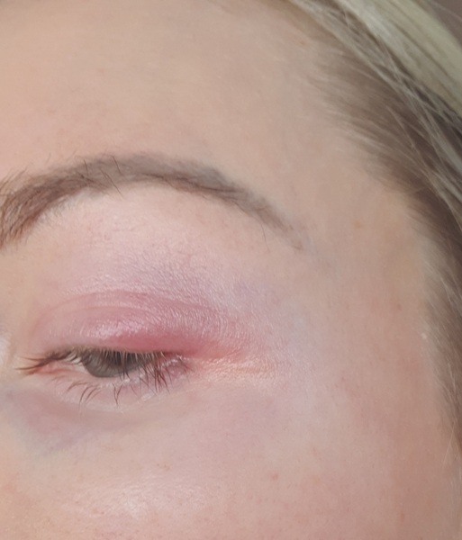 Swollen and very painful eyelid