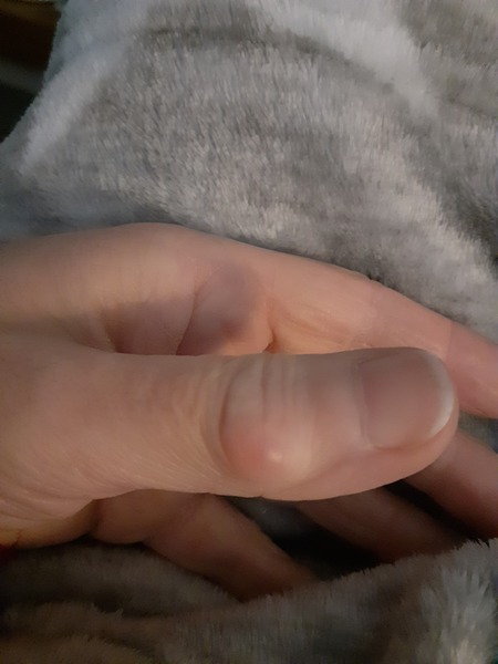 Is this just osteoarthritis or do I have a cyst too?