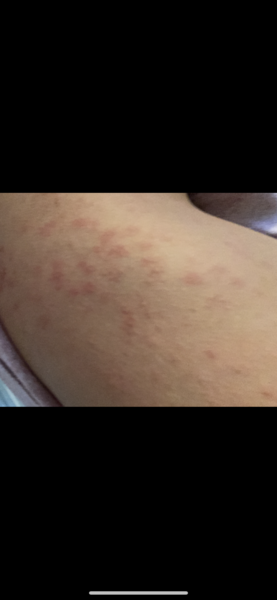 Please help! Huge rash getting worse