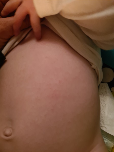 Eczema and milk allergy