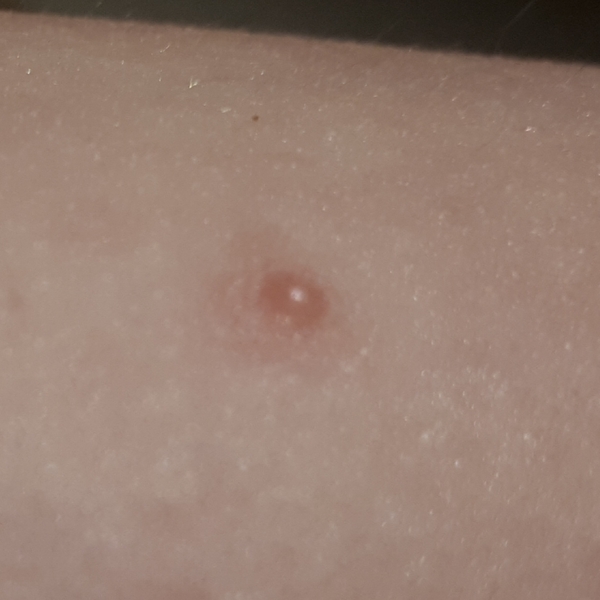 This is chickenpox, isn't it?