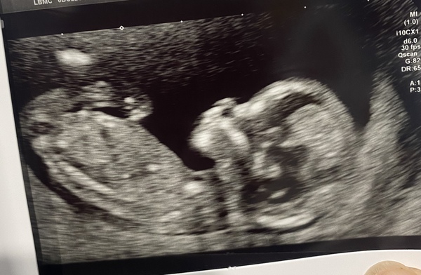 Boy or Girl?