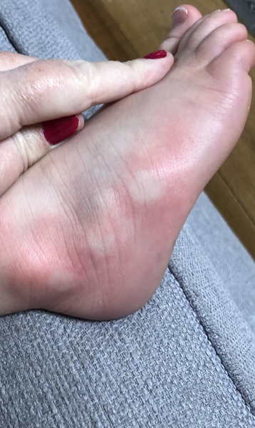 Toddler with covid foot?