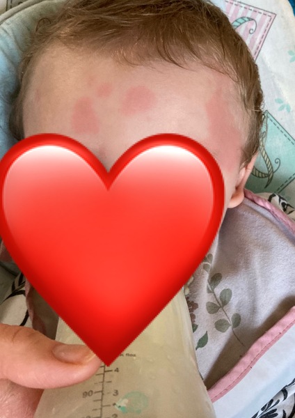 Weird blotchy marks on babies face?