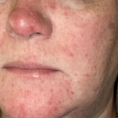 Does this look like rosacea?