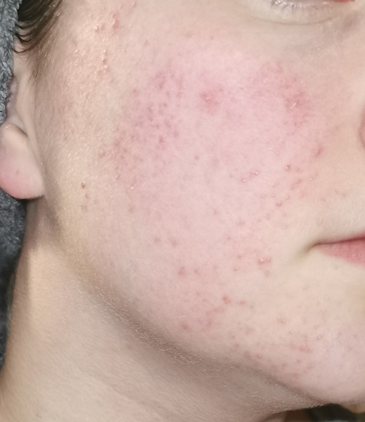 Does this look like rosacea?