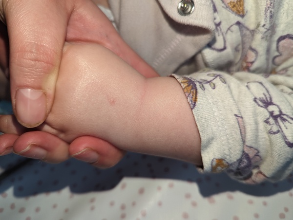 Is it chicken pox?