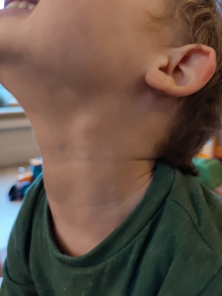Lump in son’s neck