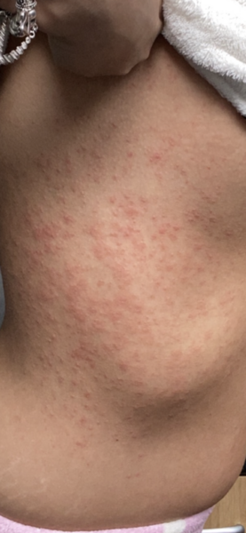 Please help! Huge rash getting worse