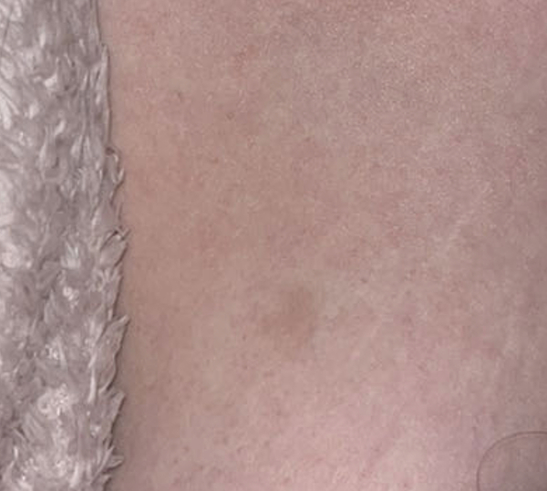 Strange mark on breast, what could it be?