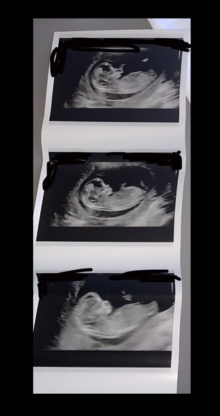 12 week scan, girl or boy?