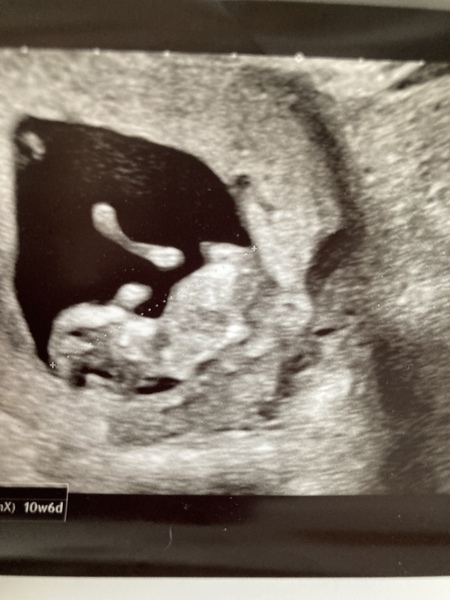 11 weeks pregnant and bleeding
