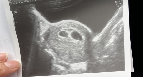 BFPs following IVF to take symptoms & scans