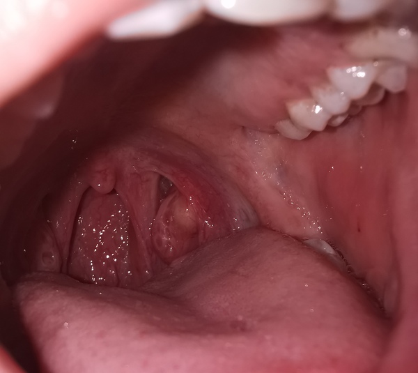 Tonsil cyst!?! 21 weeks pregnant