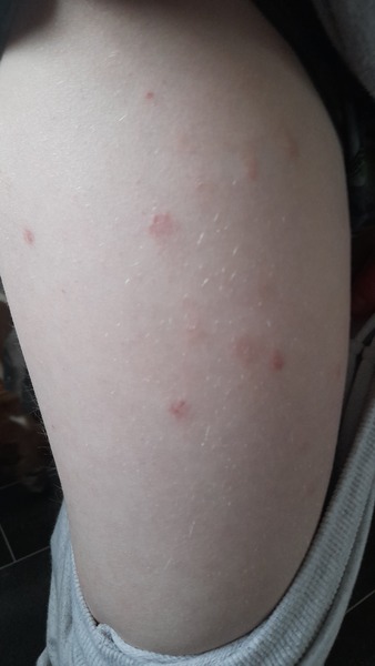 Ezcema or Ringworm or Something else