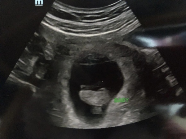 Early scan pics?