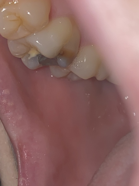 Dental query