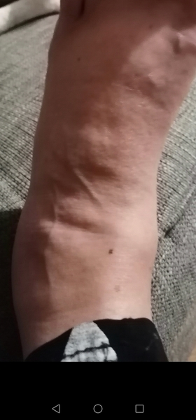 Swollen foot at night.