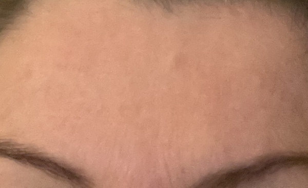 Tell me about Botox?