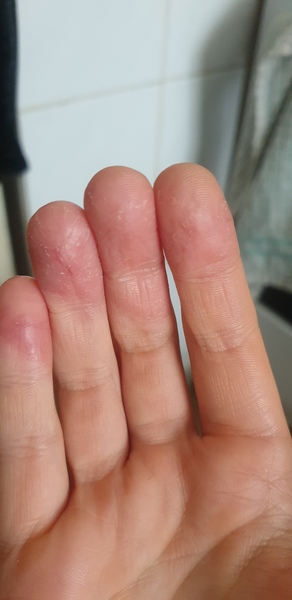 What is happening to my hands?!