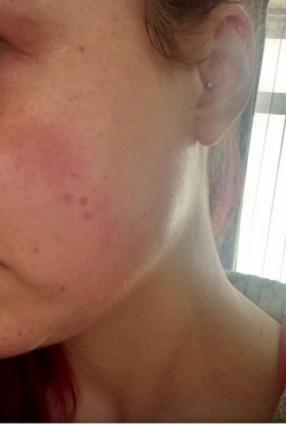 Pigmentation appearing on face please help!!