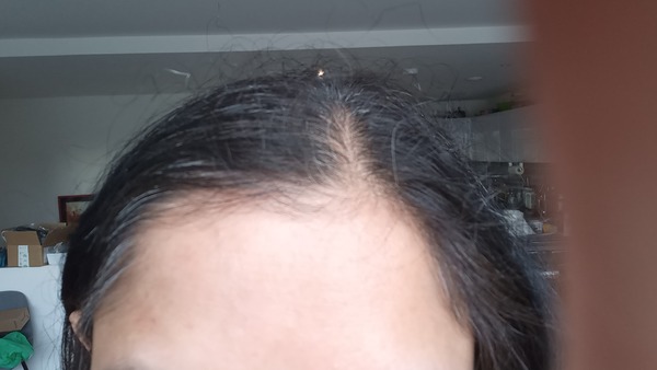 Aibu to wonder if Botox and fillers now normal?