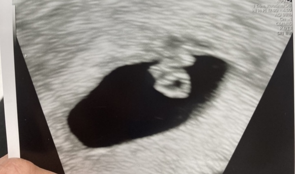BFPs following IVF to take symptoms & scans