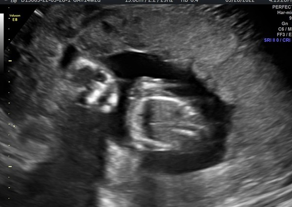 Due September 2022 (Thread 5!)
