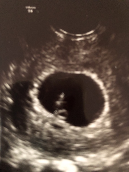 IVF Pregnancies (thread 2)