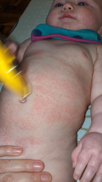 Non-itchy rash on baby for about 6 weeks now. WTH is it??