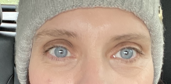 Any tips for under eye recesses (pic included)