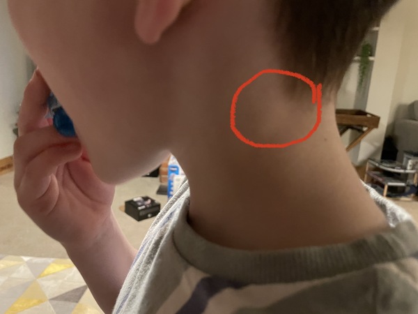 Lump in son’s neck