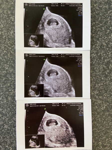 Gender prediction 7weeks scan (Just for fun)