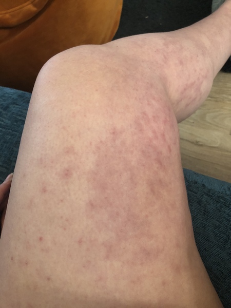 Blue/purple colour on leg