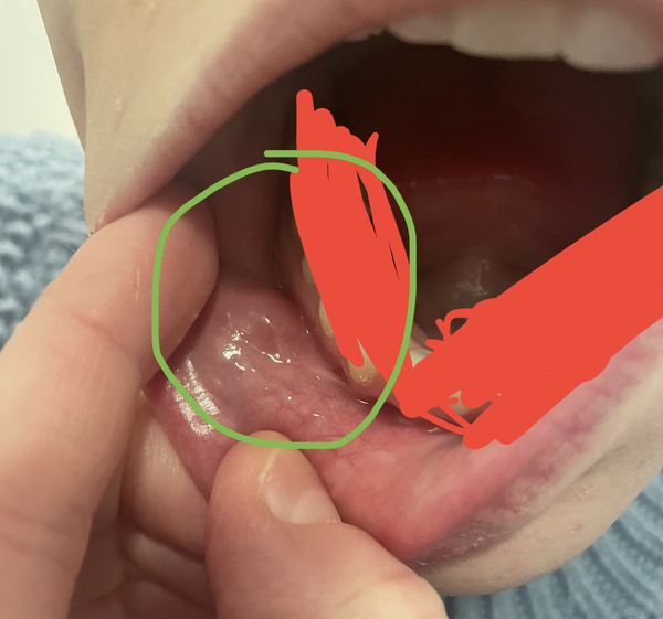 Fucking mouth ulcer. Please help