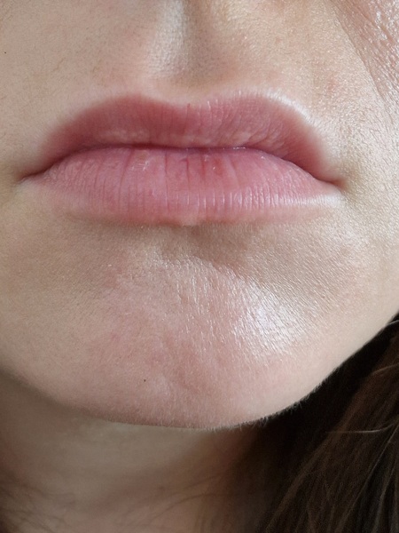 Lip fillers - help!