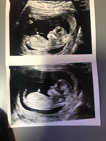 Boy or girl, nub theory ?!