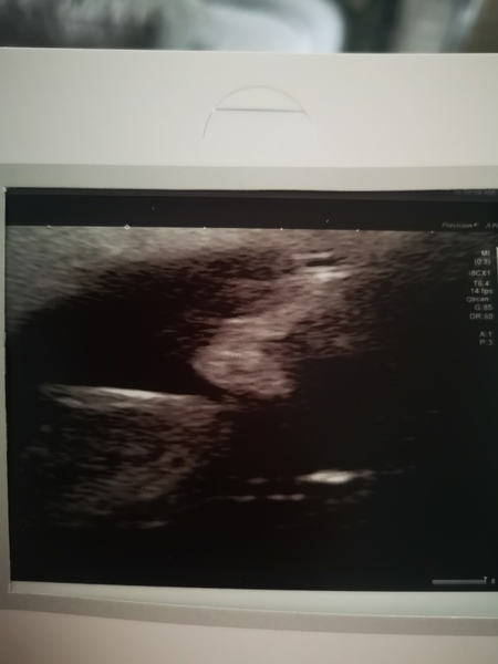 Navigating pregnancy after loss