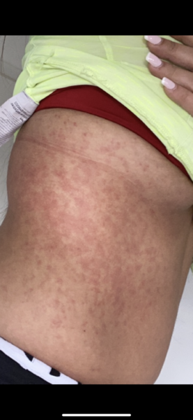 Please help! Huge rash getting worse
