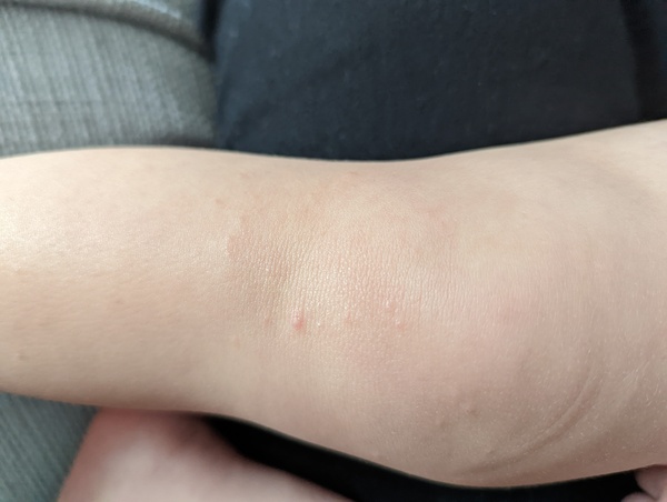 Is it chicken pox?