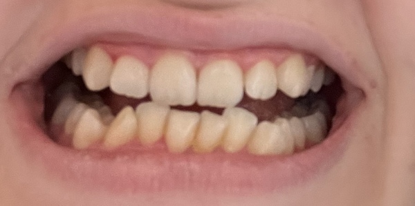 What can be done to help crooked teeth?