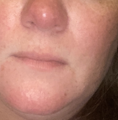 Does this look like rosacea?