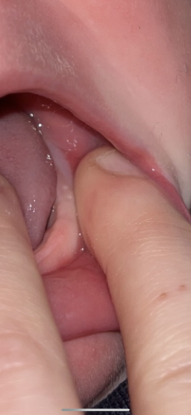 Baby’s teeth (5 Months)