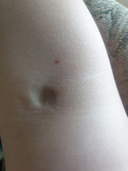 Cover scar advise