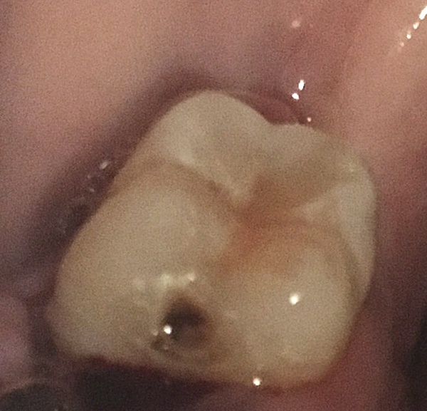 To think my dentist shouldn’t have missed this huge hole?