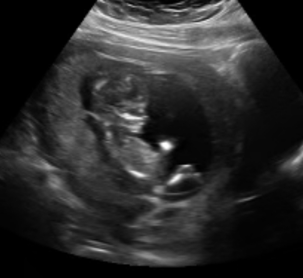 Guess the sex? Scan pic