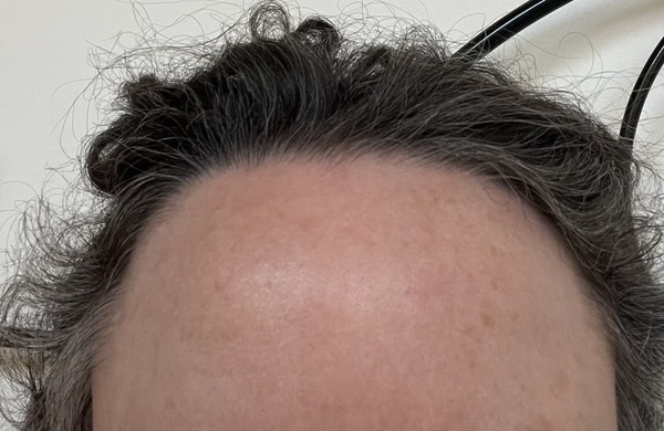 Aibu to wonder if Botox and fillers now normal?
