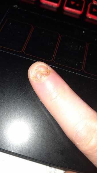unintentional self mutilation
