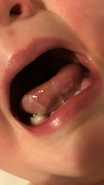 Ulcers on tongue